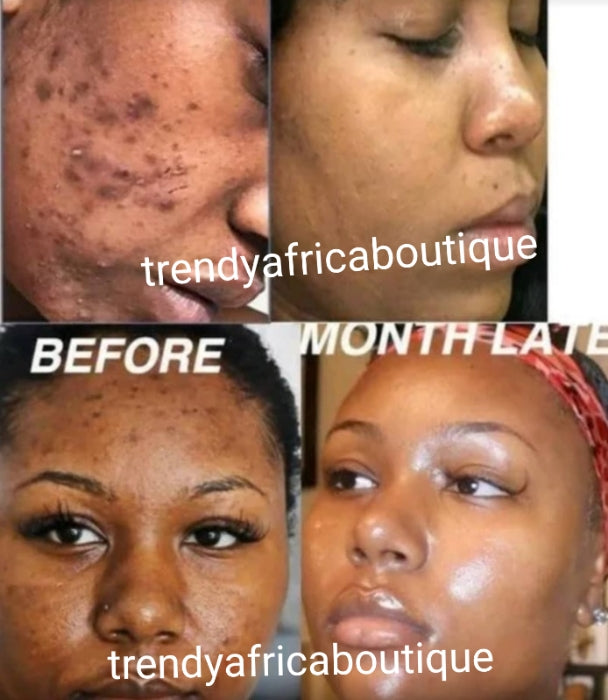 New product alert; Glitzluxury Anti Acne face cream and facial transparent soap for ALL skin type: get rid of pimples; Black heads/white heads, UNCLOG PORES: Visible Results in 7 to 10 days Active ingredient is Salicylic acid, green tea etc.