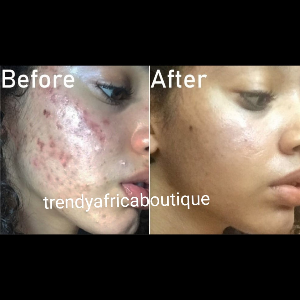 New product alert; Glitzluxury Anti Acne face cream and facial transparent soap for ALL skin type: get rid of pimples; Black heads/white heads, UNCLOG PORES: Visible Results in 7 to 10 days Active ingredient is Salicylic acid, green tea etc.