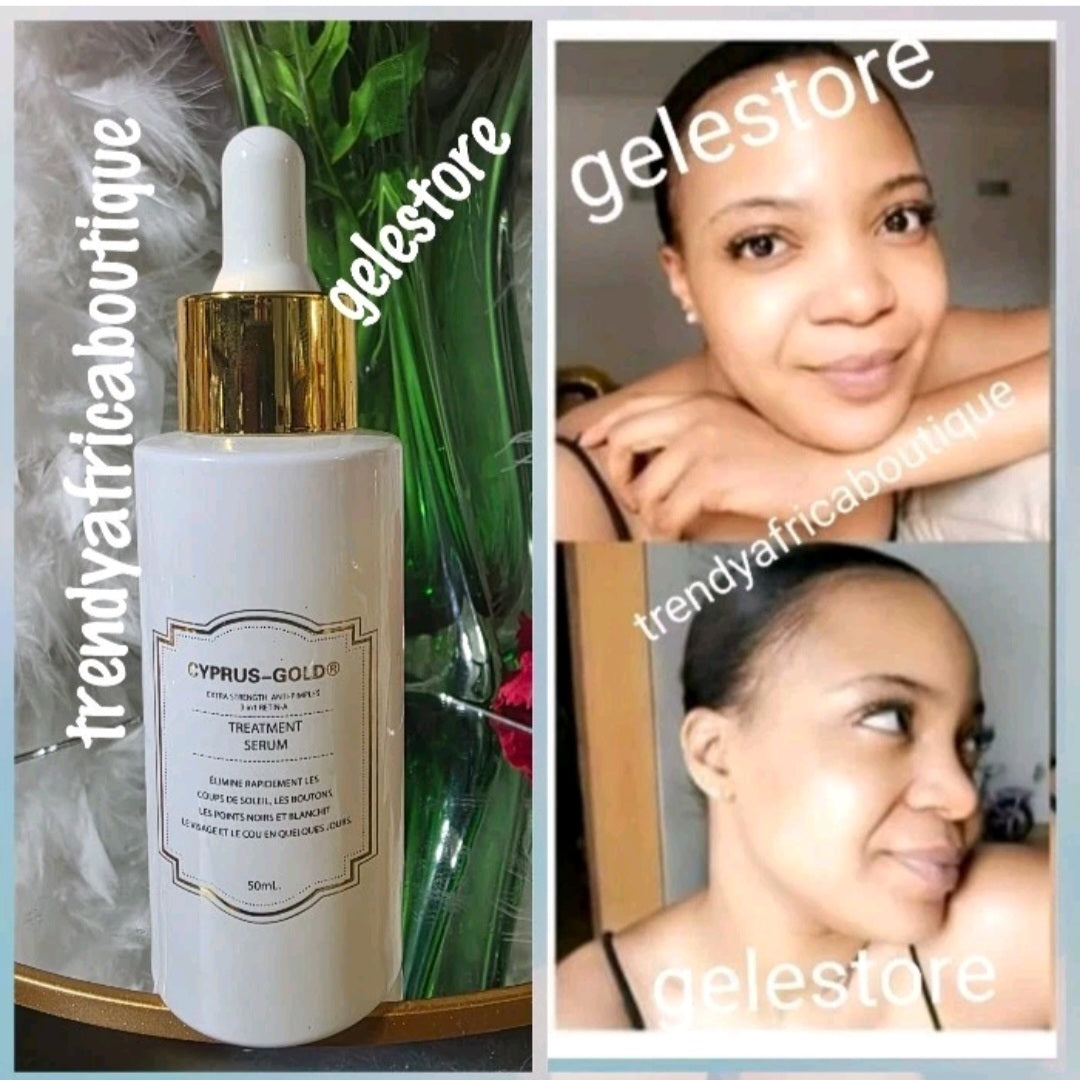 New product alert: Cyprus Gold extra strenght 3 in 1 anti pimples treatment serum. 50ml x 1. Anti knuckles, black heads