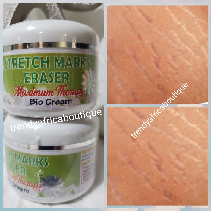 Evob Stretch Marks Eraser maximum therapy Bio cream 150g jar  x1  sale.